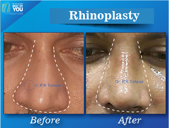 nose job surgery result